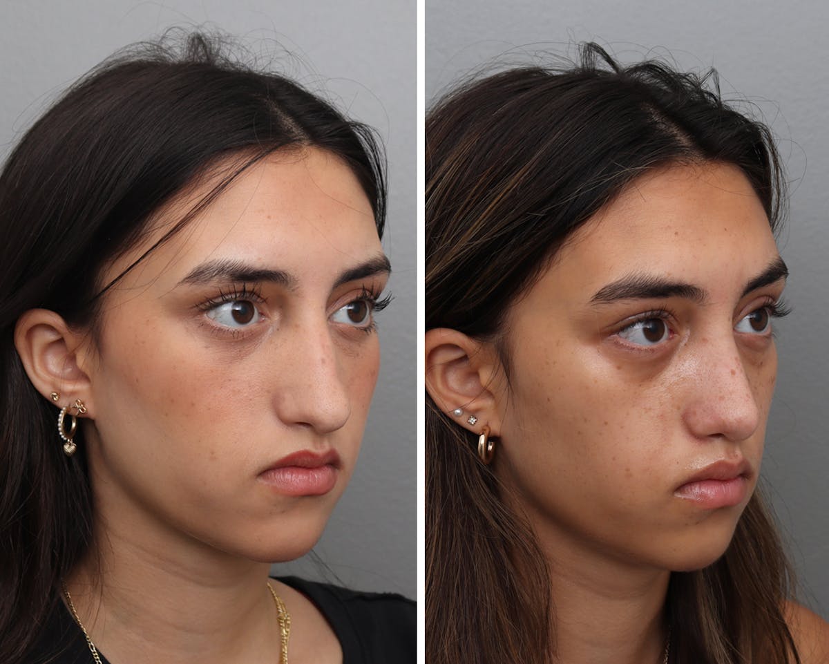 Rhinoplasty Before & After Gallery - Patient 207808 - Image 3