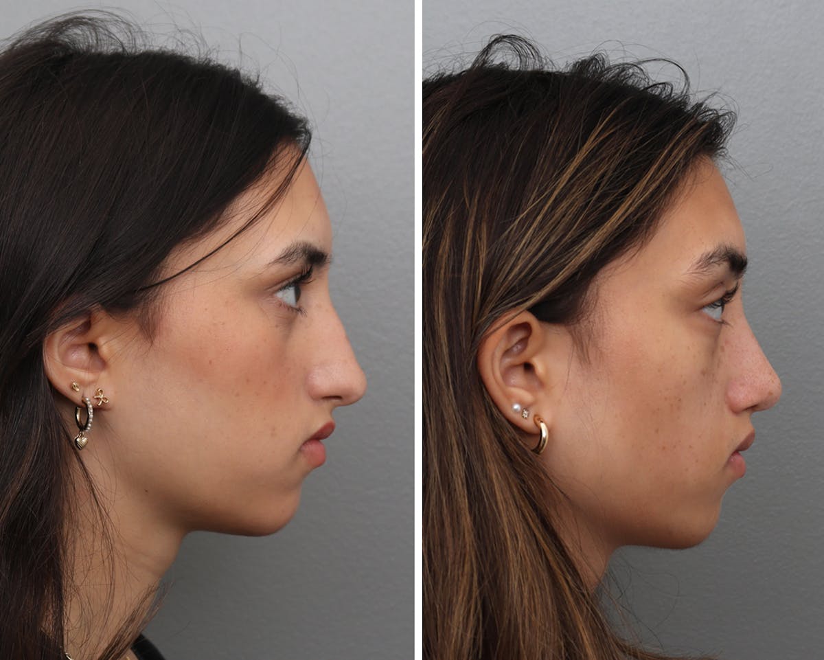 Rhinoplasty Before & After Gallery - Patient 207808 - Image 1