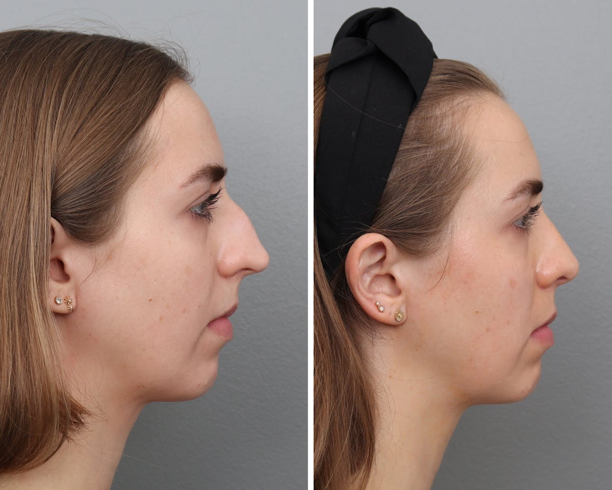 Rhinoplasty Before & After Gallery - Patient 181439 - Image 1