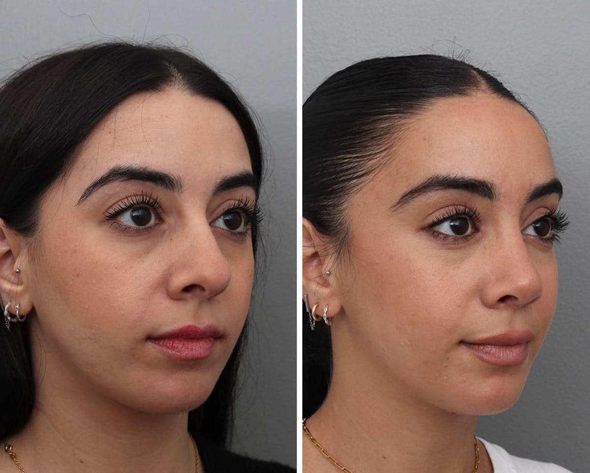 Rhinoplasty Before & After Gallery - Patient 228429 - Image 1