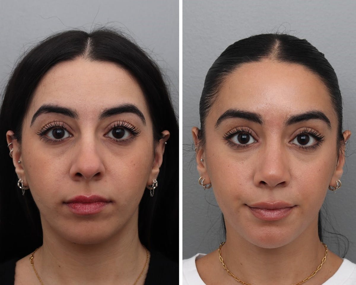 Rhinoplasty Before & After Gallery - Patient 228429 - Image 2