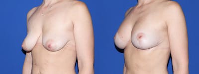 Breast Lift with Implants Before & After Gallery - Patient 384177 - Image 1