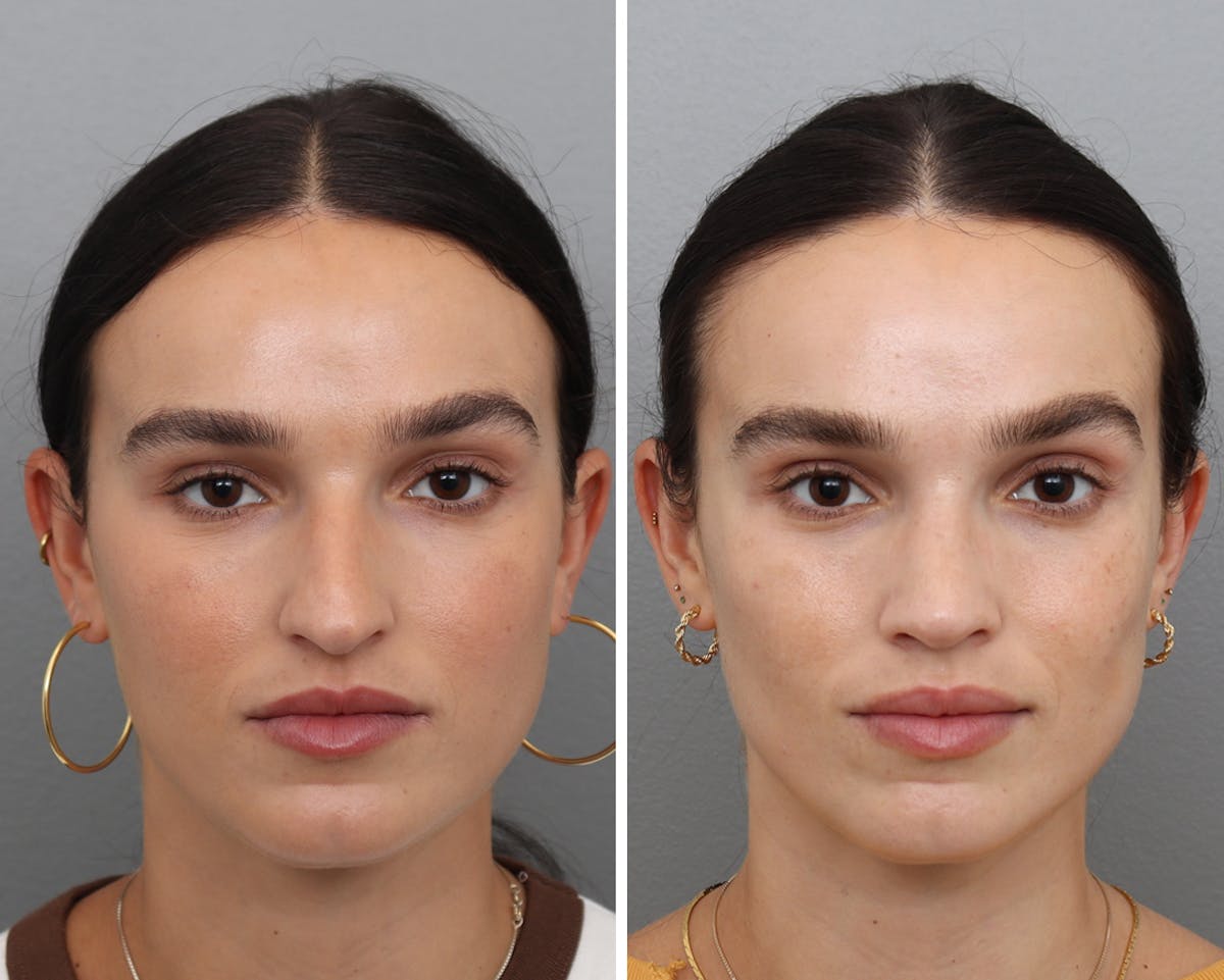 Rhinoplasty Before & After Gallery - Patient 302140 - Image 1