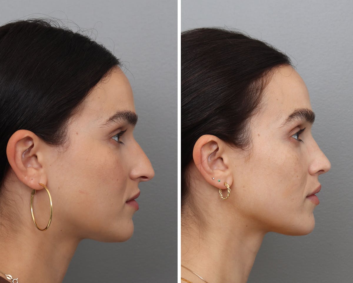 Rhinoplasty Before & After Gallery - Patient 302140 - Image 2