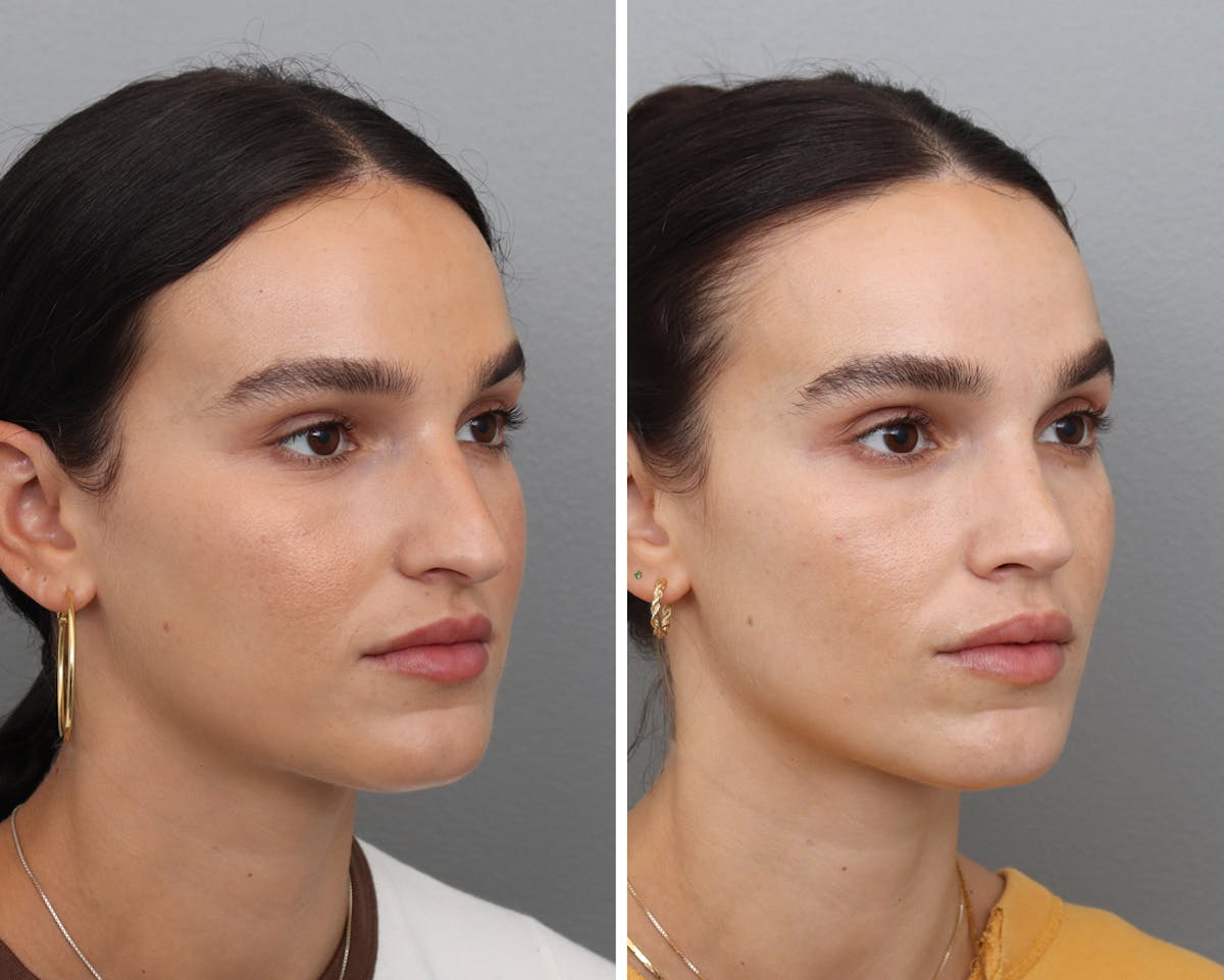 Rhinoplasty Before & After Gallery - Patient 302140 - Image 3
