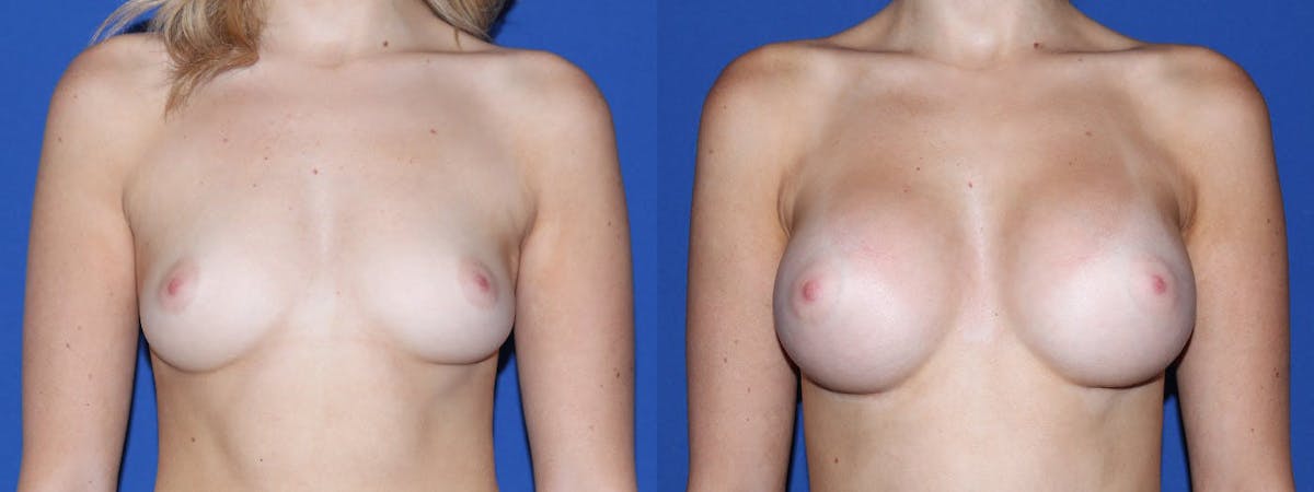 Breast Augmentation Before & After Gallery - Patient 244714 - Image 2