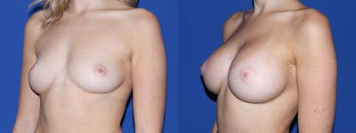 Breast Augmentation Before & After Gallery - Patient 244714 - Image 1