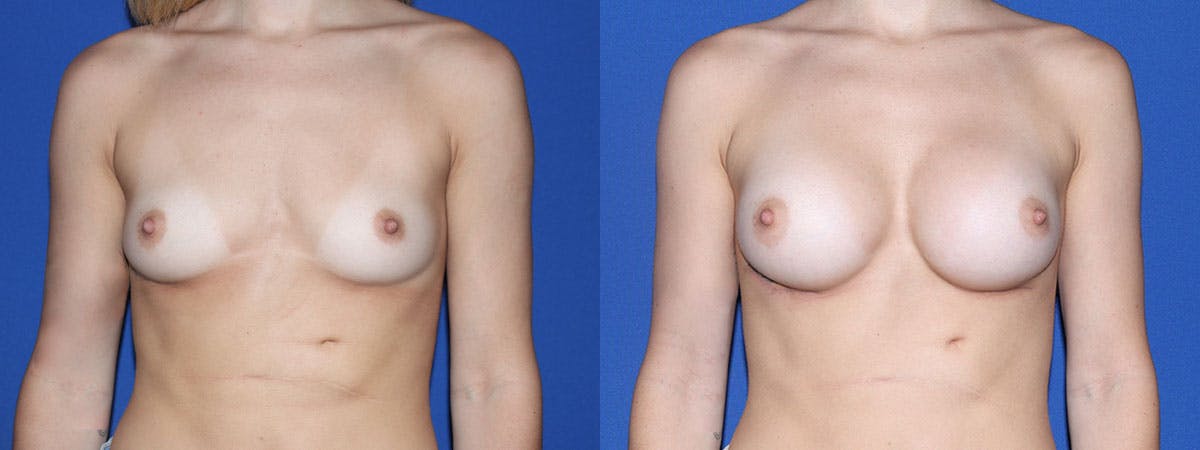 Breast Augmentation Before & After Gallery - Patient 438679 - Image 2