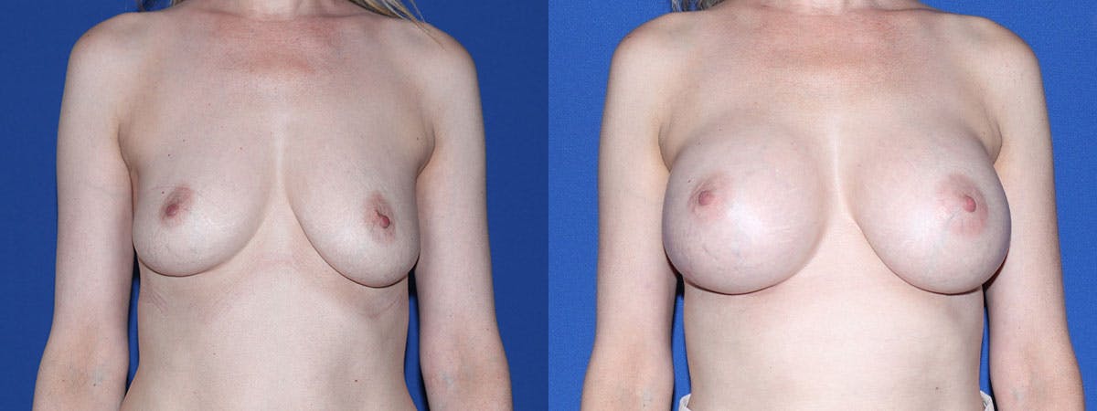 Breast Augmentation Before & After Gallery - Patient 361434 - Image 2