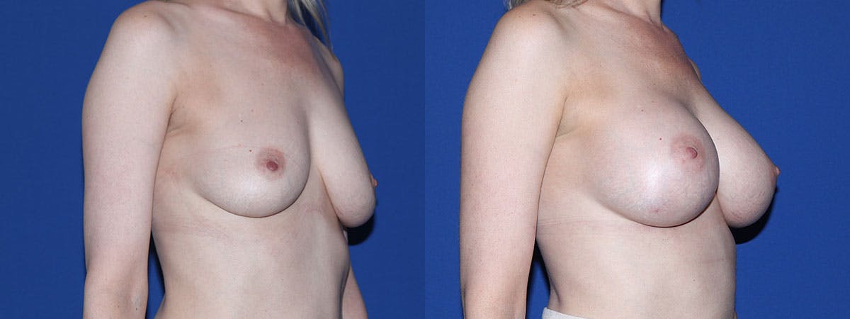 Breast Augmentation Before & After Gallery - Patient 361434 - Image 3