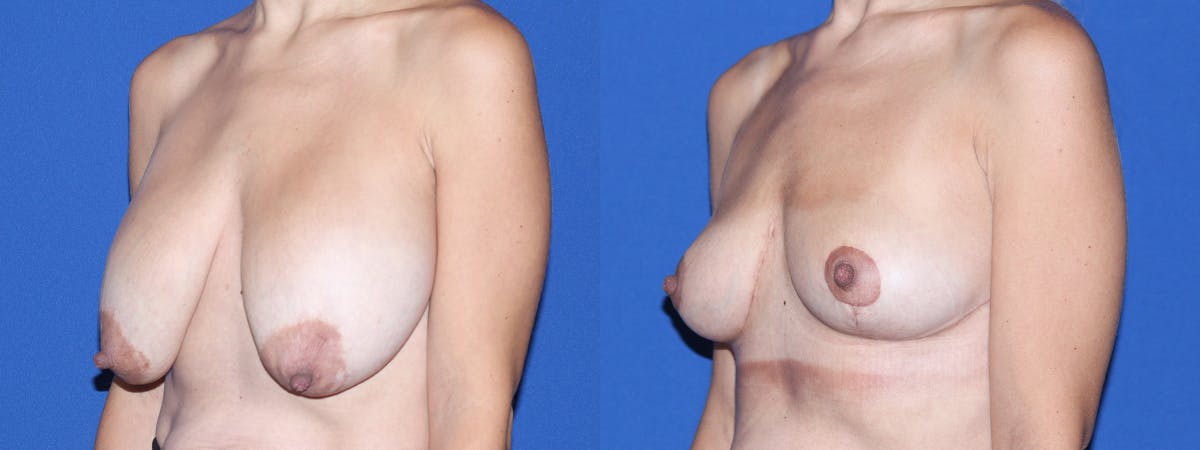 Breast Lift - Mastopexy Before & After Gallery - Patient 260286 - Image 1