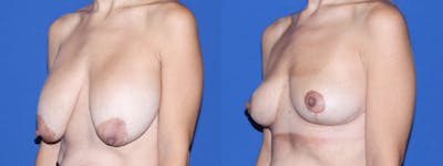 Breast Lift - Mastopexy Before & After Gallery - Patient 260286 - Image 1