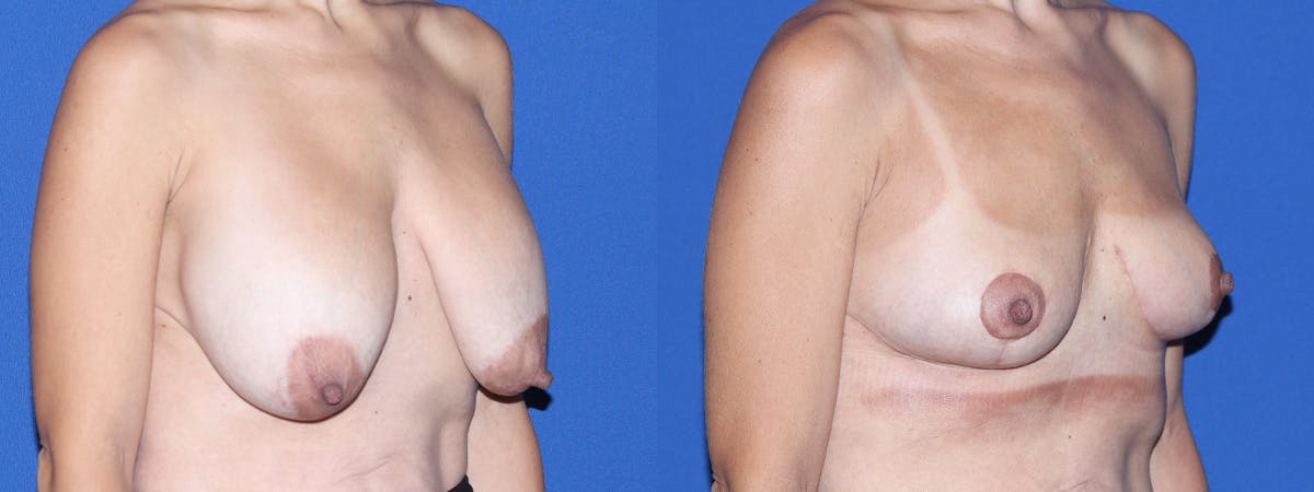Breast Lift - Mastopexy Before & After Gallery - Patient 260286 - Image 3