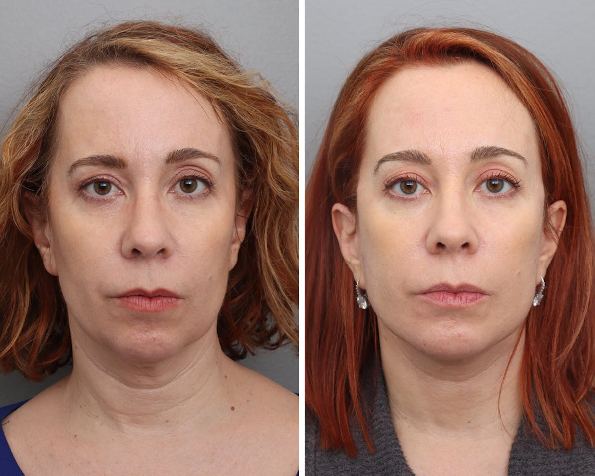 Facelift Before & After Gallery - Patient 276822 - Image 3