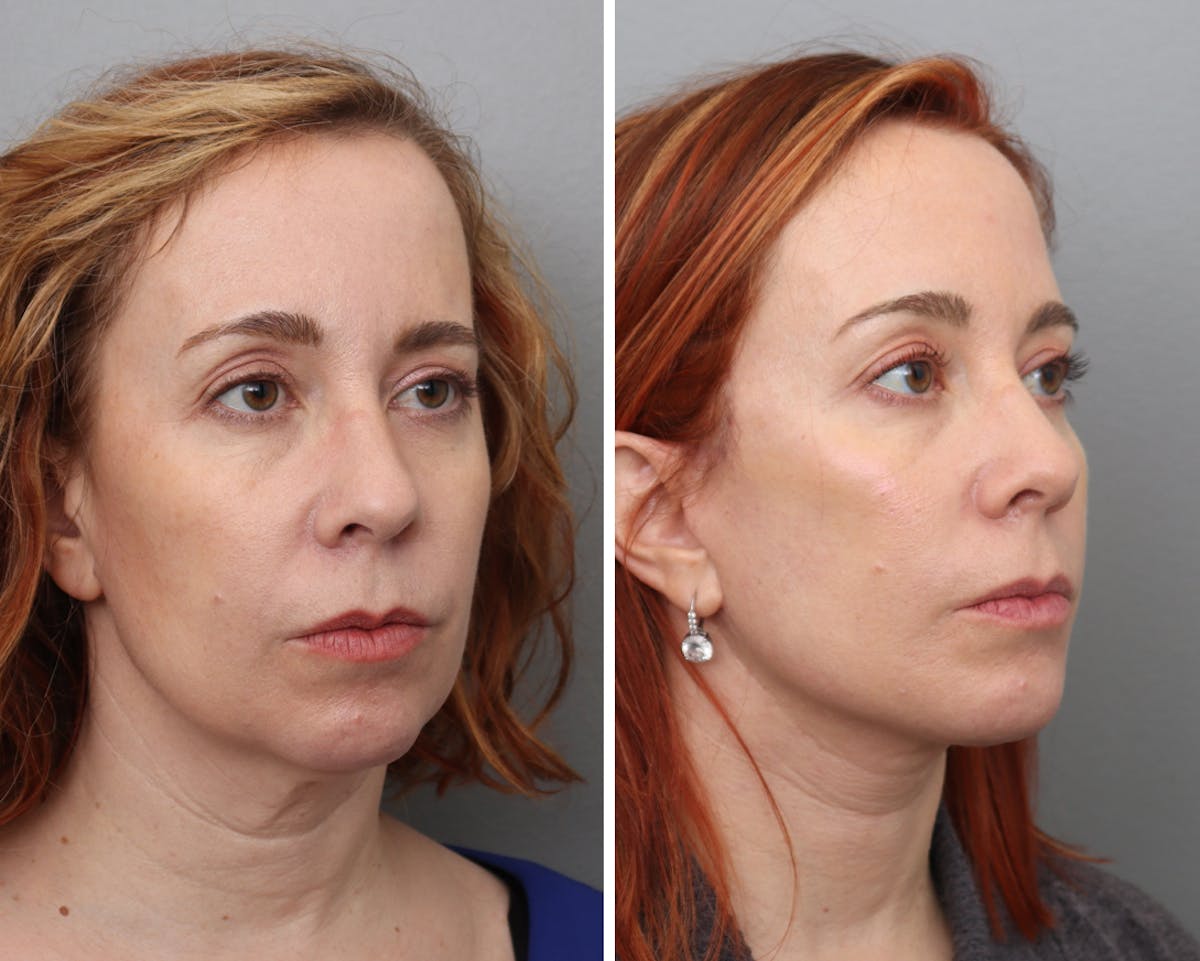 Facelift Before & After Gallery - Patient 276822 - Image 2