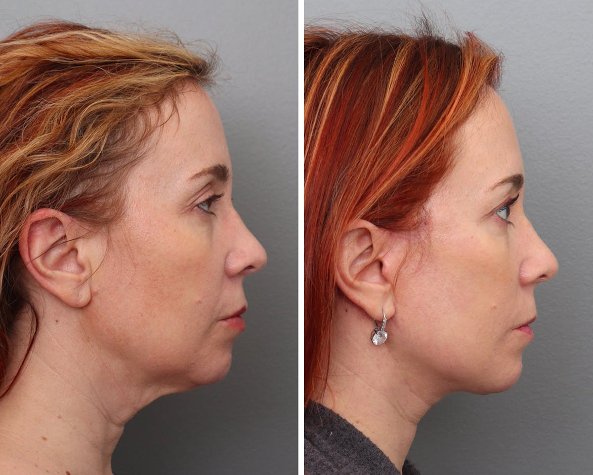 Facelift Before & After Gallery - Patient 276822 - Image 1