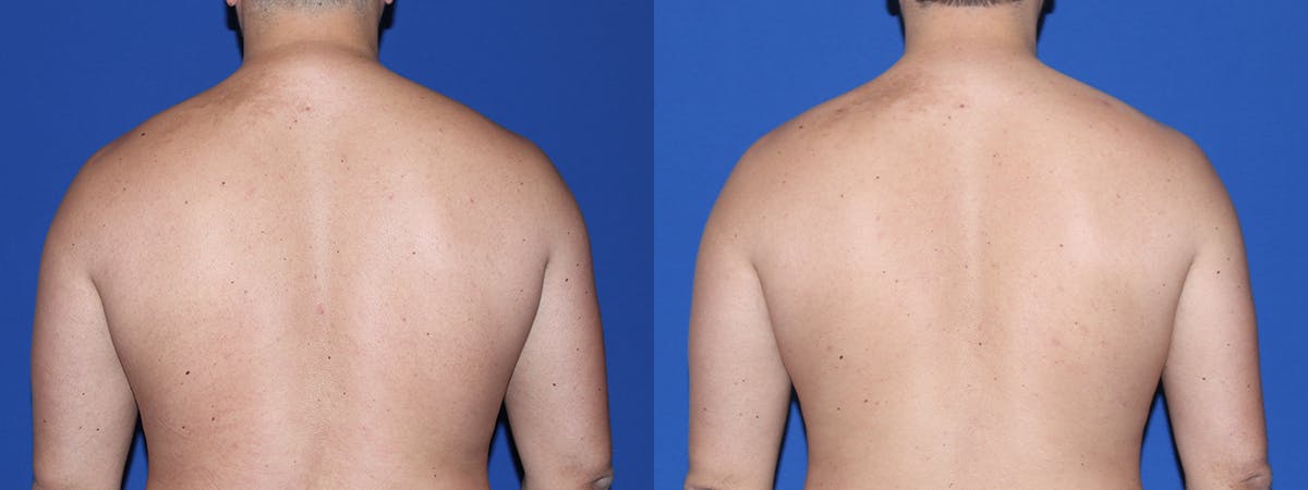 Buffalo Hump Liposuction Before & After Gallery - Patient 260801 - Image 1