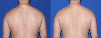 Buffalo Hump Liposuction Before & After Gallery - Patient 260801 - Image 1