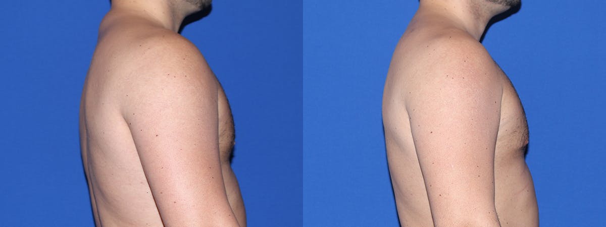 Buffalo Hump Liposuction Before & After Gallery - Patient 260801 - Image 2