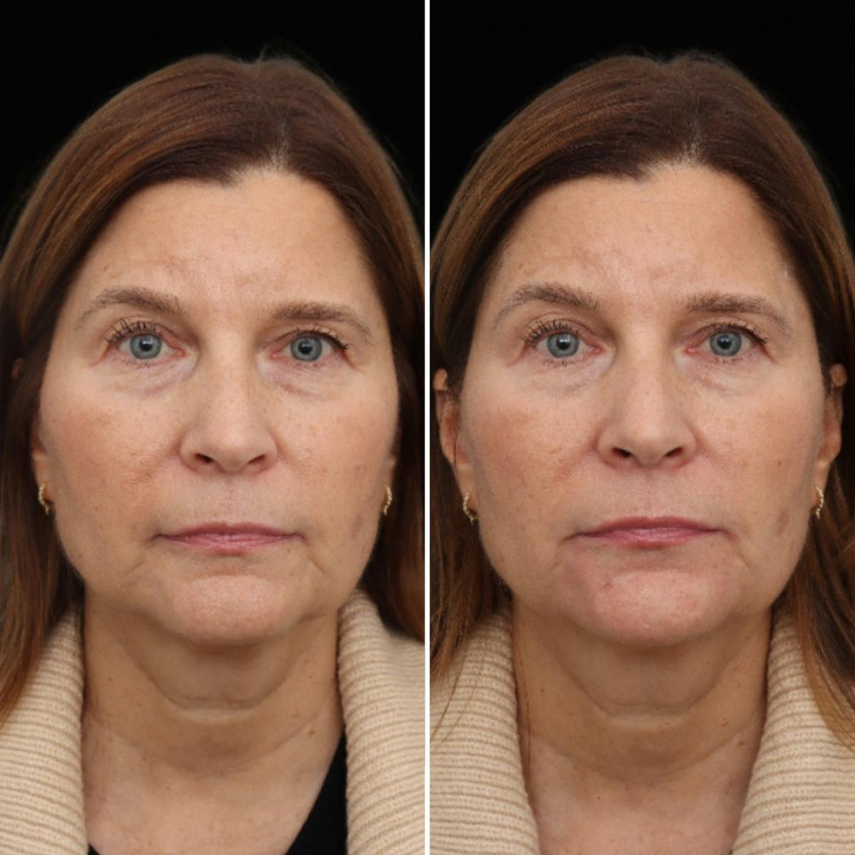 Jawline/Chin Before & After Gallery - Patient 610212 - Image 1