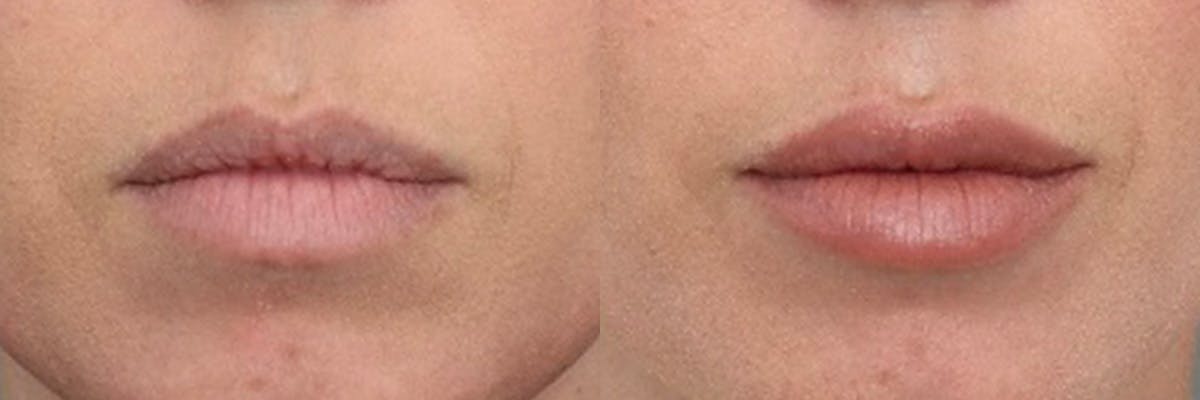 Lip Augmentation Before & After Gallery - Patient 303460 - Image 1