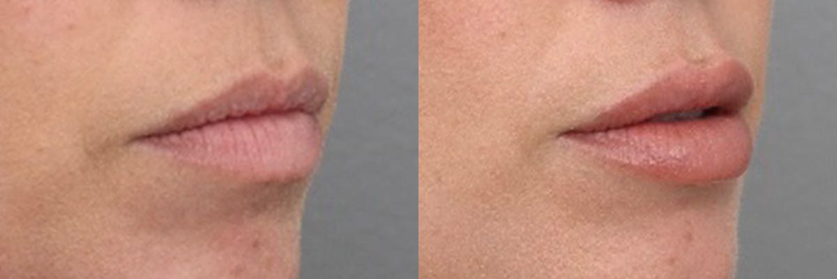 Lip Augmentation Before & After Gallery - Patient 303460 - Image 3