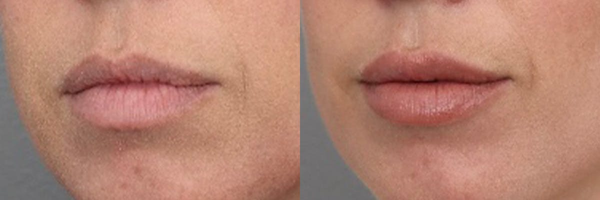 Lip Augmentation Before & After Gallery - Patient 303460 - Image 2