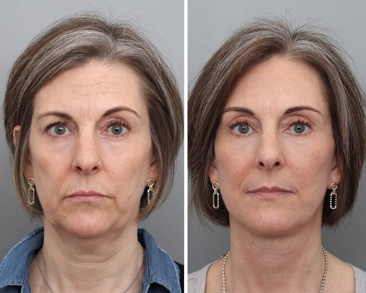 Facelift Before & After Gallery - Patient 259081 - Image 1