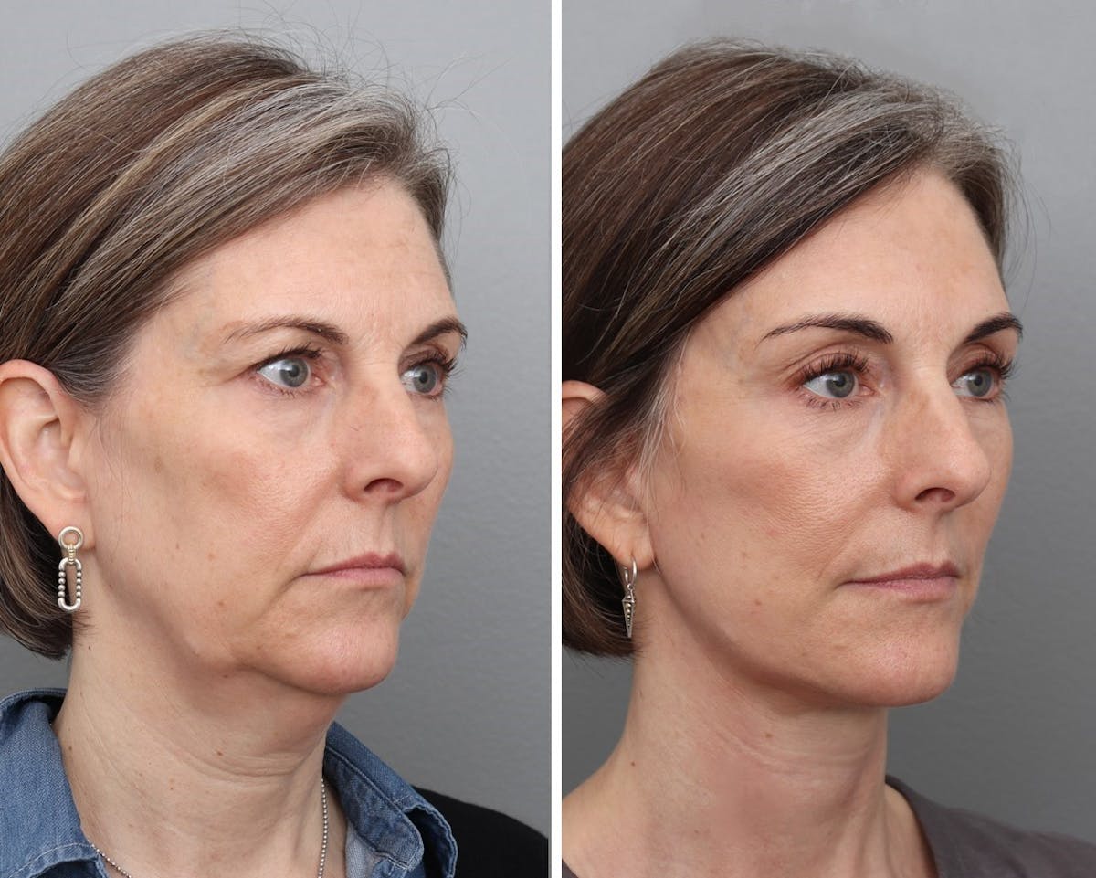 Facelift Before & After Gallery - Patient 259081 - Image 2