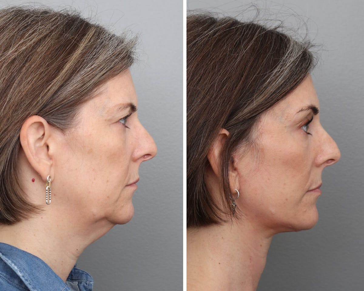 Facelift Before & After Gallery - Patient 259081 - Image 3