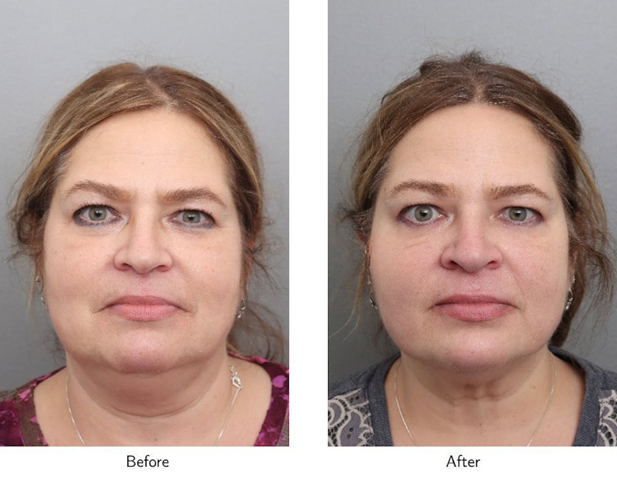 Non-Surgical Facelift Before & After Gallery - Patient 340050 - Image 1