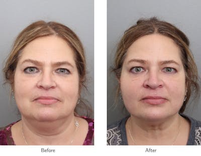 Non-Surgical Facelift Before & After Gallery - Patient 340050 - Image 1