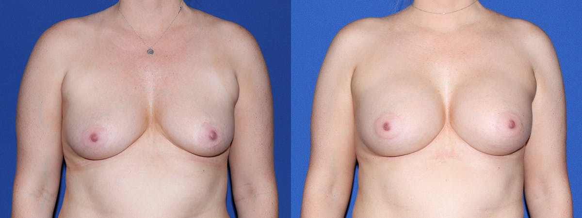 Breast Augmentation Before & After Gallery - Patient 234868 - Image 2