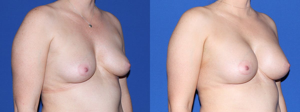 Breast Augmentation Before & After Gallery - Patient 234868 - Image 3