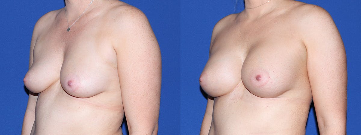 Breast Augmentation Before & After Gallery - Patient 234868 - Image 1