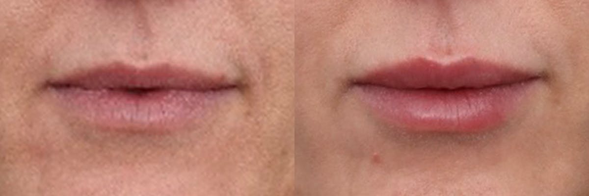 Lip Augmentation Before & After Gallery - Patient 314384 - Image 1