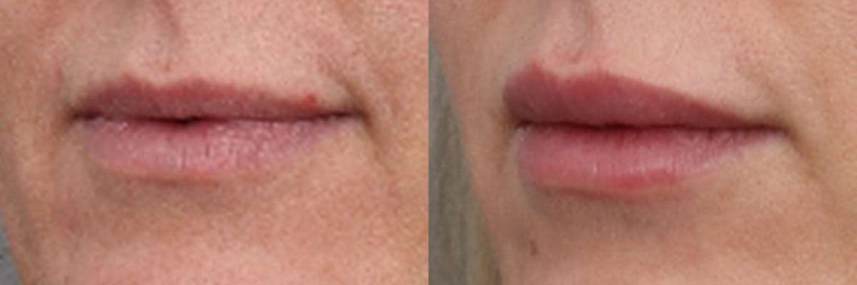 Lip Augmentation Before & After Gallery - Patient 314384 - Image 2