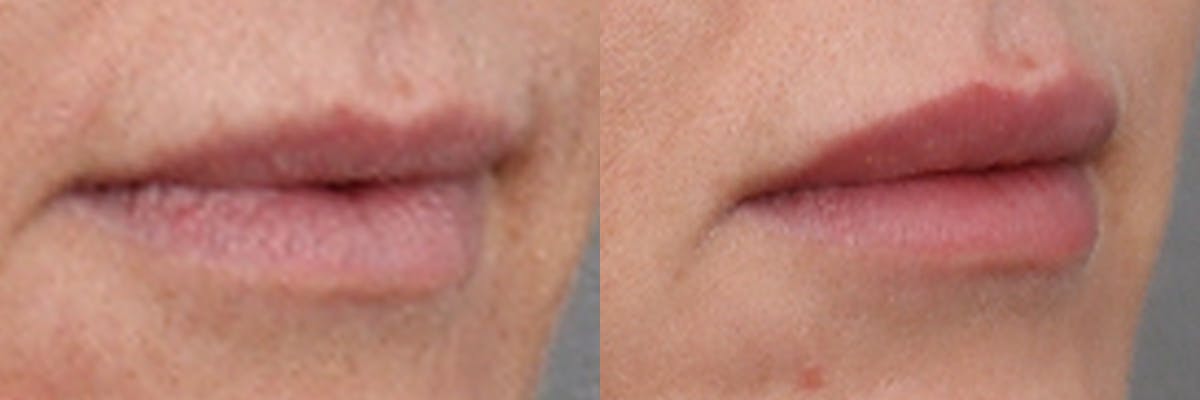 Lip Augmentation Before & After Gallery - Patient 314384 - Image 3