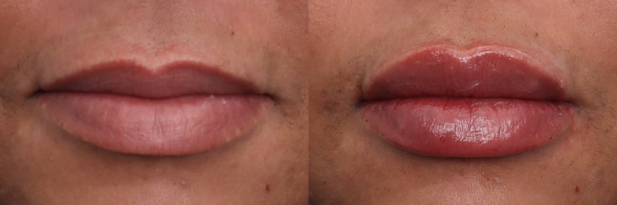 Lip Augmentation Before & After Gallery - Patient 124456 - Image 1
