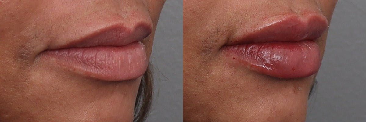 Lip Augmentation Before & After Gallery - Patient 124456 - Image 2