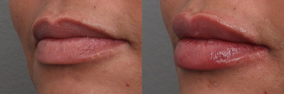 Lip Augmentation Before & After Gallery - Patient 124456 - Image 3