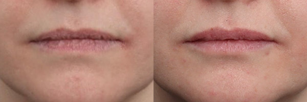 Lip Augmentation Before & After Gallery - Patient 147333 - Image 1