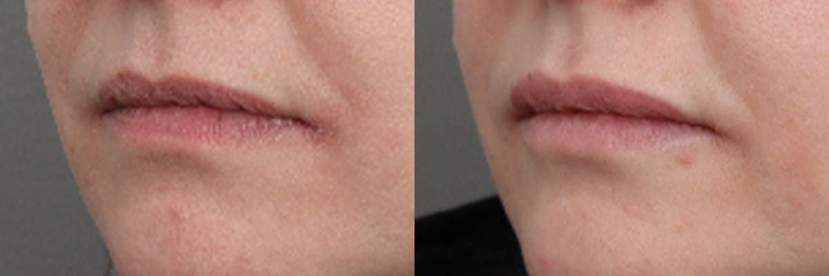 Lip Augmentation Before & After Gallery - Patient 147333 - Image 3