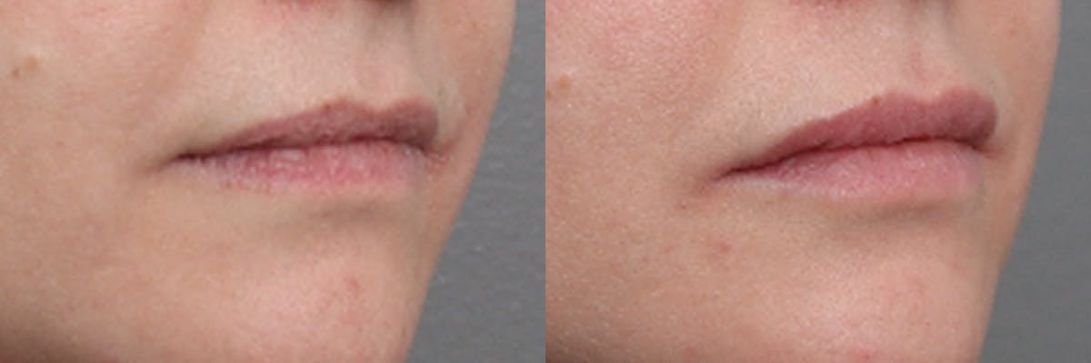 Lip Augmentation Before & After Gallery - Patient 147333 - Image 2