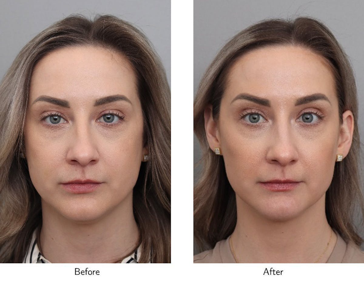 Non-Surgical Facelift Before & After Gallery - Patient 706261 - Image 1