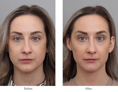Non-Surgical Facelift Before & After Gallery - Patient 706261 - Image 1