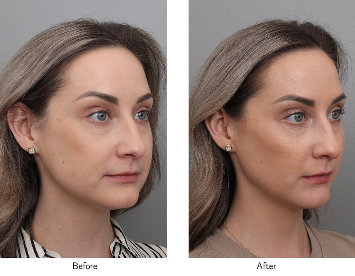 Non-Surgical Facelift Before & After Gallery - Patient 706261 - Image 2