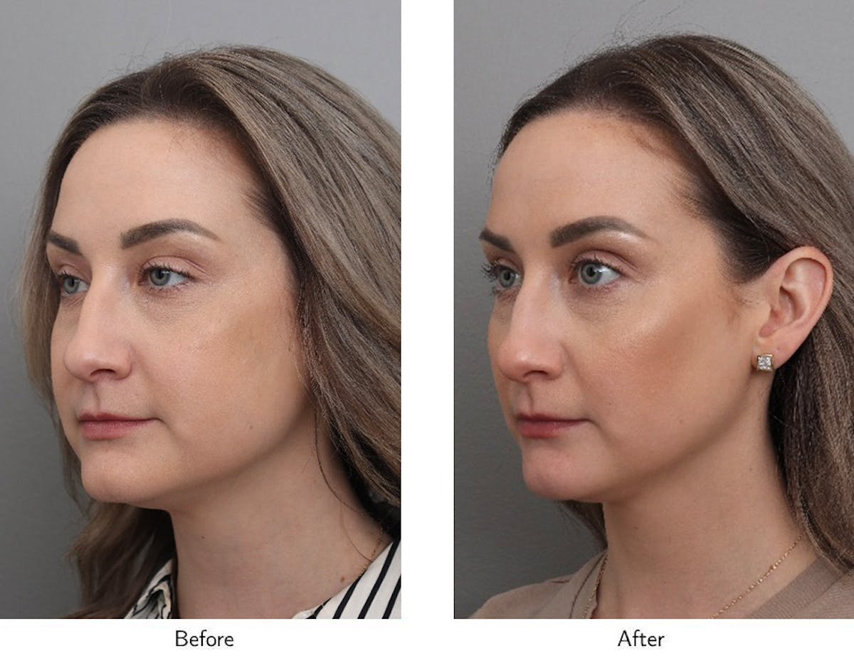 Non-Surgical Facelift Before & After Gallery - Patient 706261 - Image 3