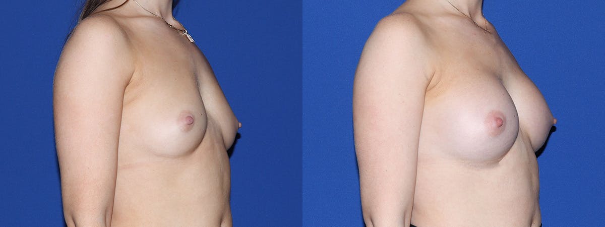 Breast Augmentation Before & After Gallery - Patient 234987 - Image 3