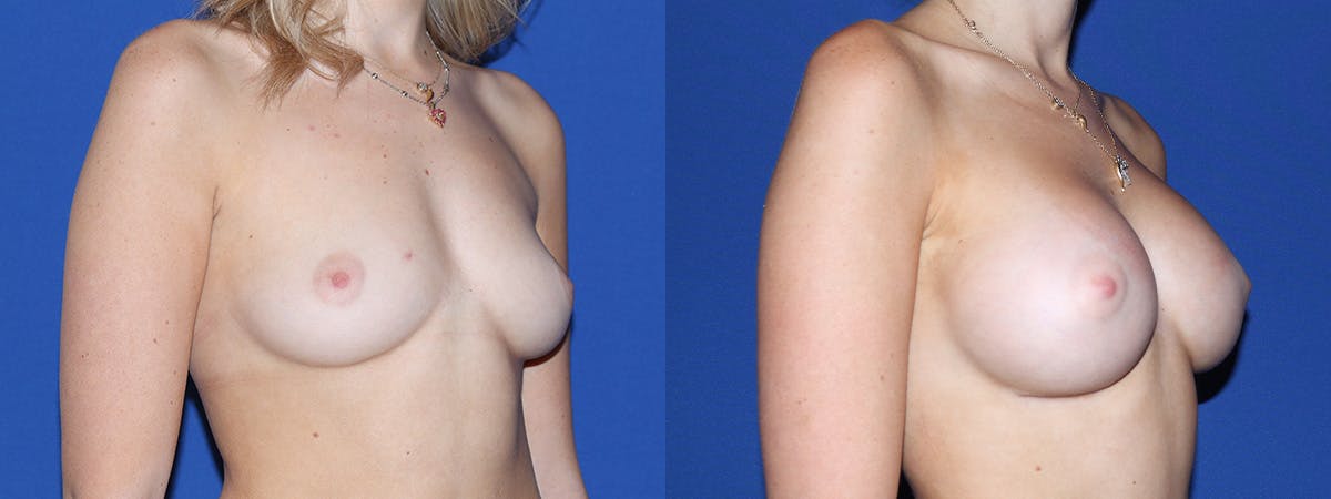 Breast Augmentation Before & After Gallery - Patient 244714 - Image 3